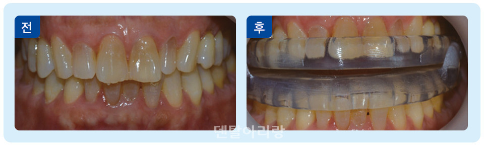 구강 내 장치 착용 전후. 사진=강동경희대병원